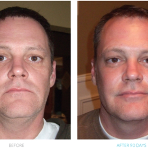 PREORDER ONLY Anti-Wrinkle/Crow's Feet/Sagging Skin - Picture 4 of 4